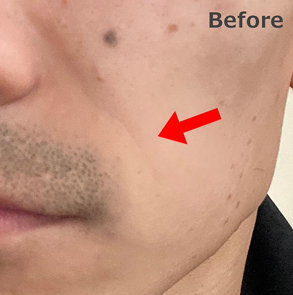 リンクルショット ほうれい線